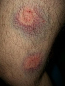 Jordi's leg bruises